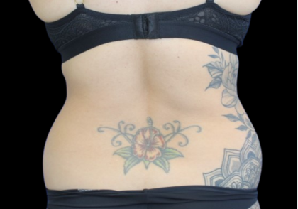 Liposuction Before & After Patient #427