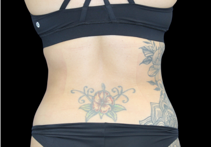 Liposuction Before & After Patient #427
