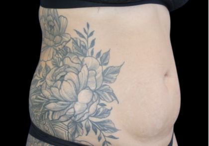 Liposuction Before & After Patient #427