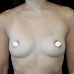 Breast Augmentation Before & After Patient #361