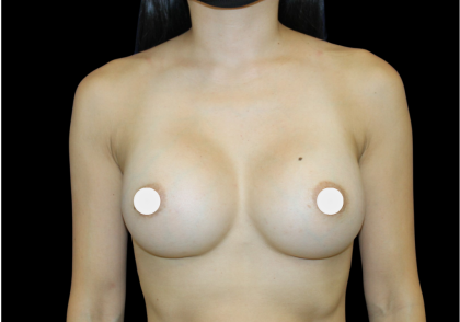 Breast Augmentation Before & After Patient #361