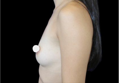 Breast Augmentation Before & After Patient #361