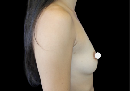 Breast Augmentation Before & After Patient #361