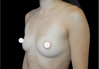 Breast Augmentation Before & After Patient #361