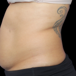 Liposuction Before & After Patient #426