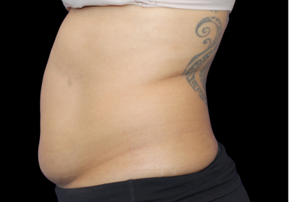 Liposuction Before & After Patient #426