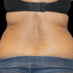 Liposuction Before & After Patient #425