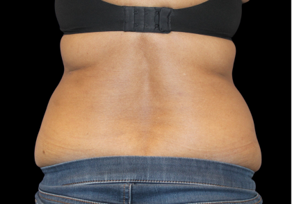 Liposuction Before & After Patient #425