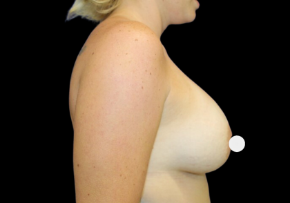 Breast Augmentation Before & After Patient #360