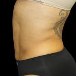 Liposuction Before & After Patient #426