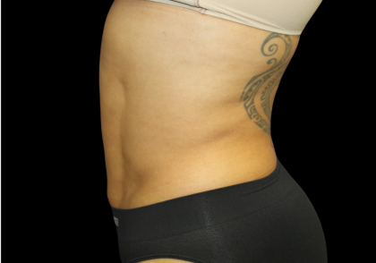 Liposuction Before & After Patient #426