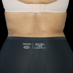 Liposuction Before & After Patient #425