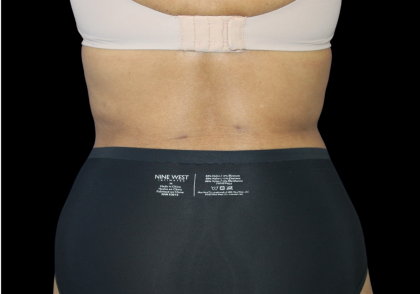 Liposuction Before & After Patient #425