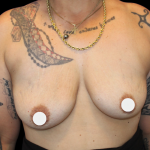 Breast Augmentation Before & After Patient #359