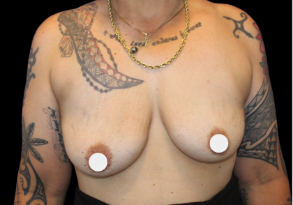 Breast Augmentation Before & After Patient #359