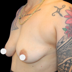Breast Augmentation Before & After Patient #359