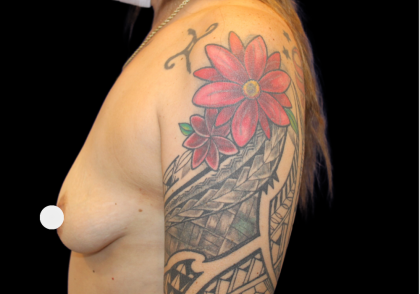 Breast Augmentation Before & After Patient #359