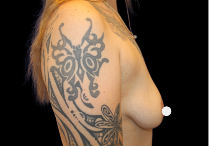 Breast Augmentation Before & After Patient #359