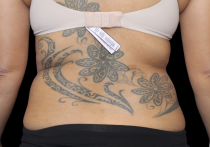 Liposuction Before & After Patient #426