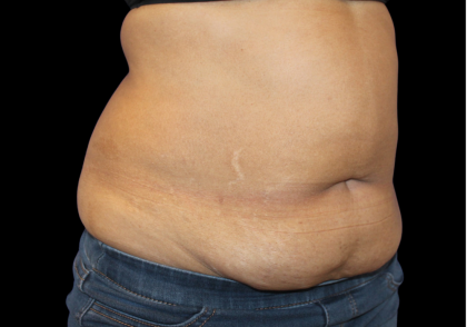 Liposuction Before & After Patient #425