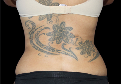 Liposuction Before & After Patient #426