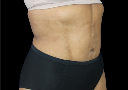 Liposuction Before & After Patient #425