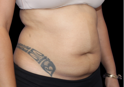 Liposuction Before & After Patient #426