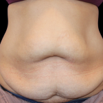 Tummy Tuck Before & After Patient #475