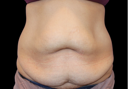 Tummy Tuck Before & After Patient #475