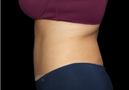 Tummy Tuck Before & After Patient #475