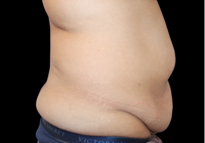 Tummy Tuck Before & After Patient #475