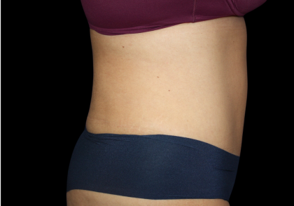 Tummy Tuck Before & After Patient #475