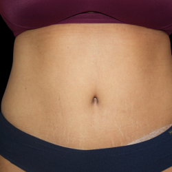 Tummy Tuck Before & After Patient #475