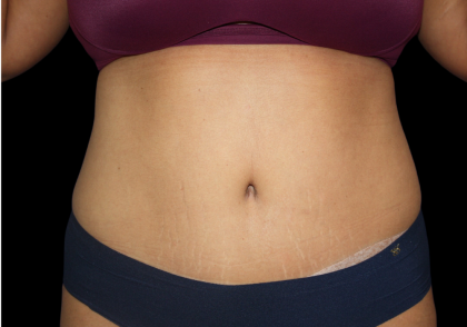 Tummy Tuck Before & After Patient #475
