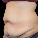 Tummy Tuck Before & After Patient #475