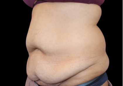 Tummy Tuck Before & After Patient #475
