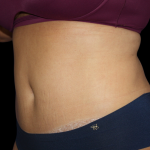 Tummy Tuck Before & After Patient #475