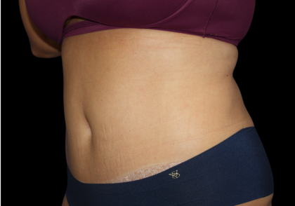 Tummy Tuck Before & After Patient #475