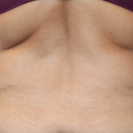 Tummy Tuck Before & After Patient #475