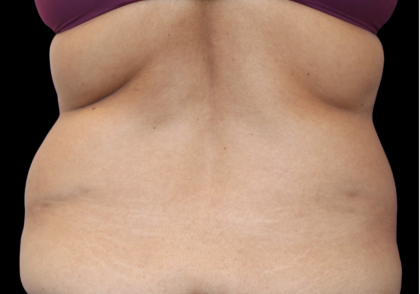 Tummy Tuck Before & After Patient #475