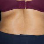 Tummy Tuck Before & After Patient #475