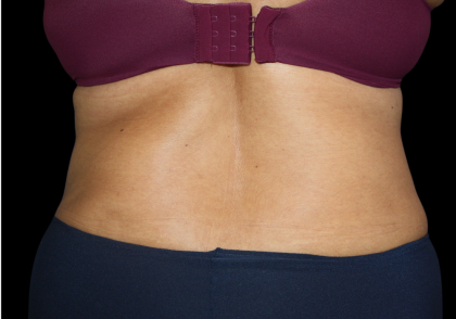 Tummy Tuck Before & After Patient #475