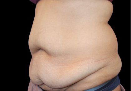 Tummy Tuck Before & After Patient #475