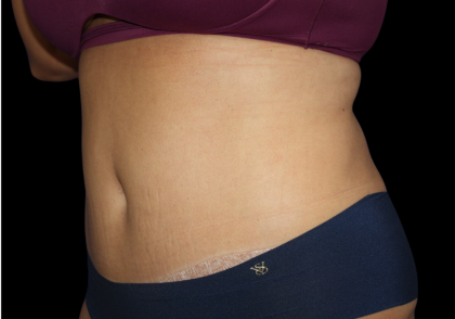 Tummy Tuck Before & After Patient #475