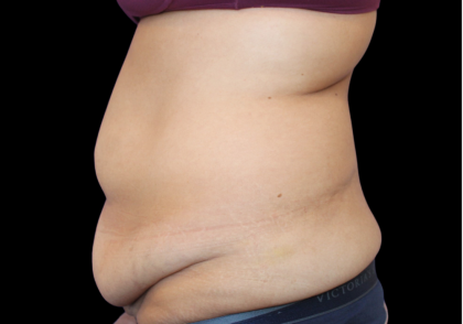 Tummy Tuck Before & After Patient #475