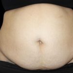 Tummy Tuck Before & After Patient #476