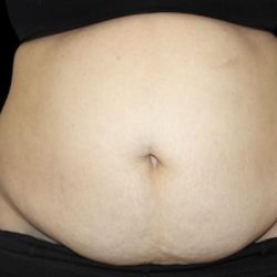 Tummy Tuck Before & After Patient #476