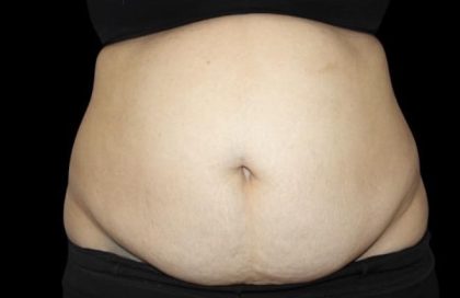 Tummy Tuck Before & After Patient #476
