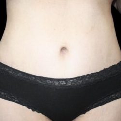 Tummy Tuck Before & After Patient #476