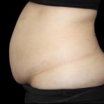 Tummy Tuck Before & After Patient #476